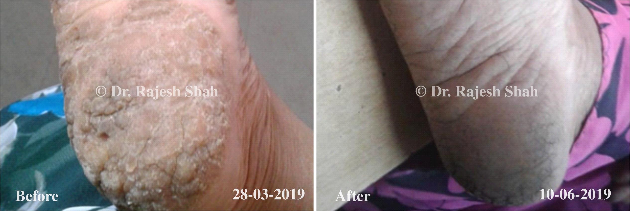 Atopic Dermatitis Before and After Case Photo