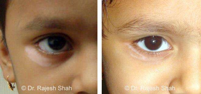 Vitiligo Before and After Case Photo