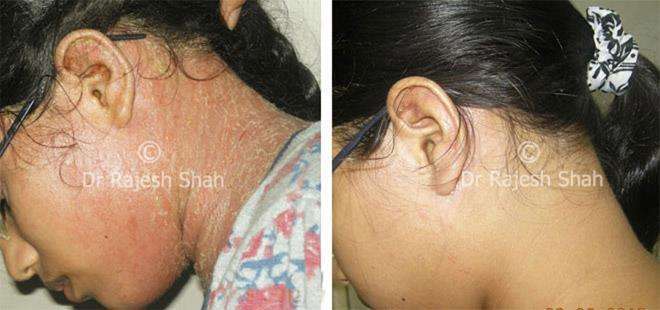 Eczema Before and After Case Photo