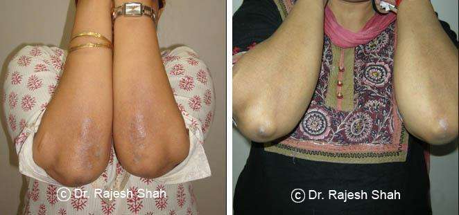 Psoriasis Before and After Case Photo