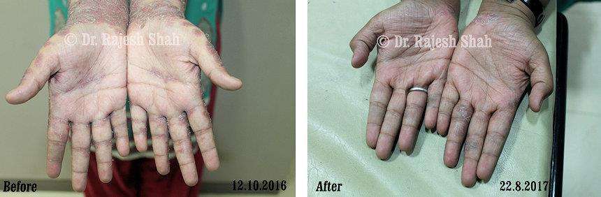 Psoriasis Before and After Case Photo