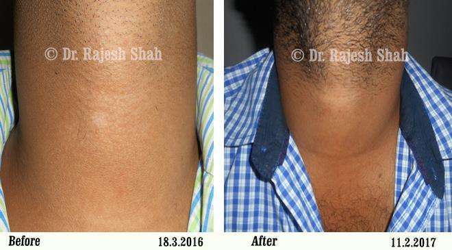 Vitiligo Before and After Case Photo