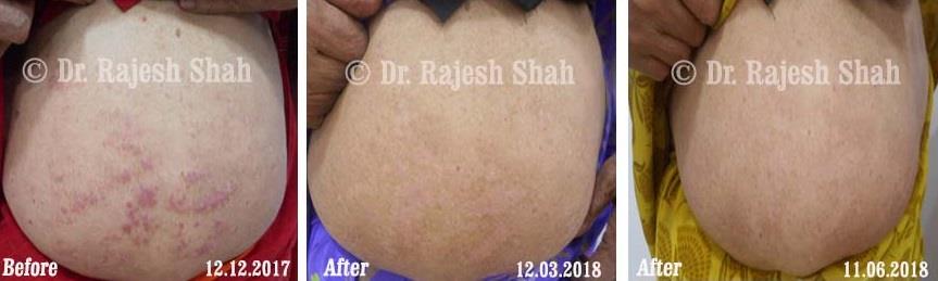 Psoriasis Before and After Case Photo