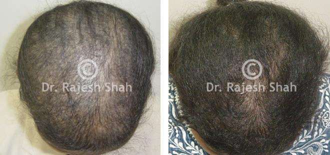 Alopecia Areata Before and After Case Photo