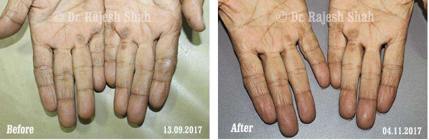 Psoriasis Before and After Case Photo