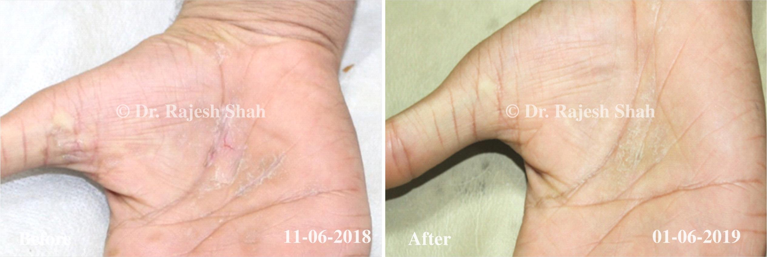 Psoriasis Before and After Case Photo