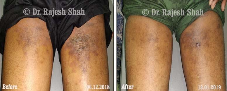 Atopic Dermatitis Before and After Case Photo