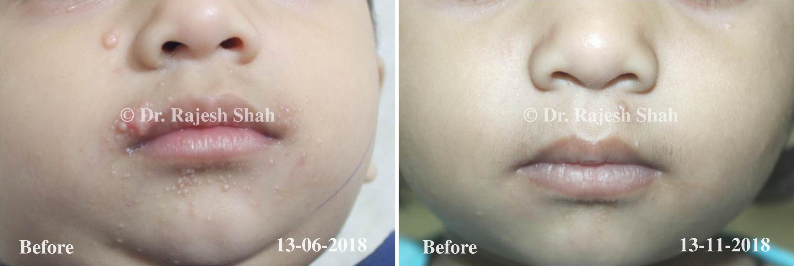 Molluscum contagiosum Before and After Case Photo