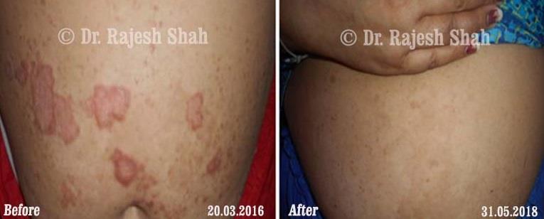 Psoriasis Before and After Case Photo
