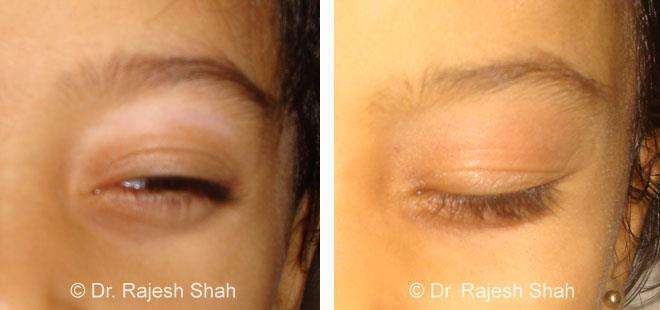 Vitiligo Before and After Case Photo