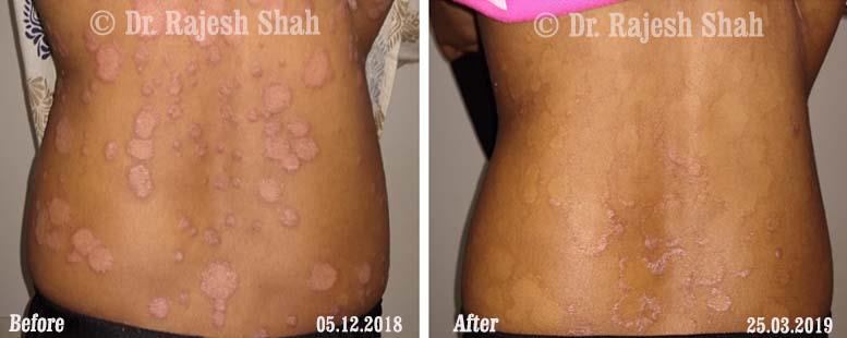 Psoriasis Before and After Case Photo
