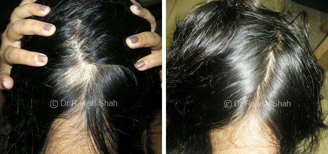 Alopecia Areata Before and After Case Photo