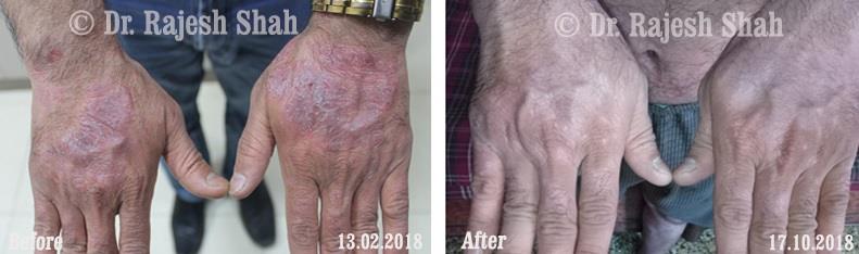 Psoriasis Before and After Case Photo