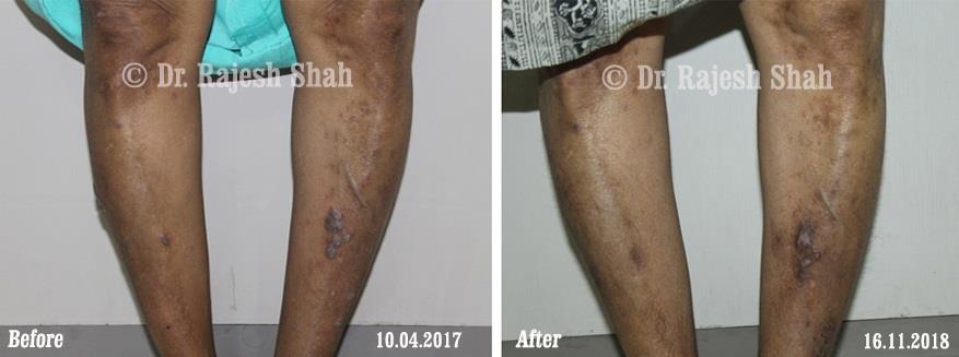 Lichen Planus Before and After Case Photo