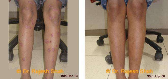 Psoriasis Before and After Case Photo