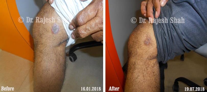 Psoriasis Before and After Case Photo