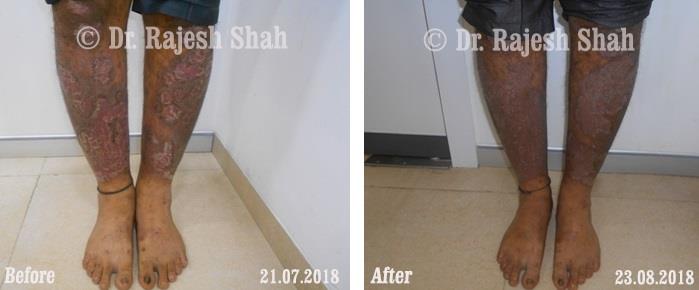 Psoriasis Before and After Case Photo