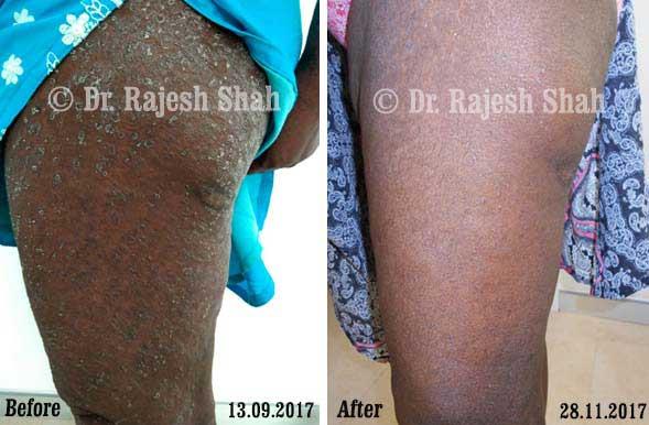 Psoriasis Before and After Case Photo