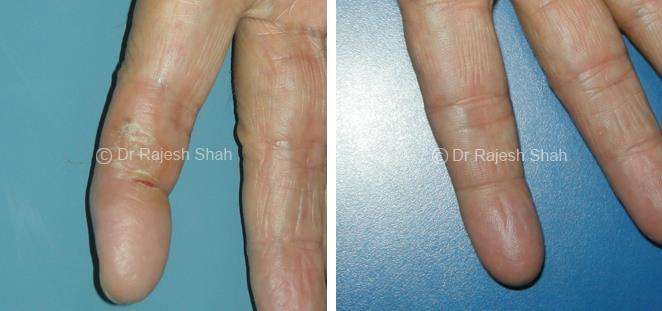 Atopic Dermatitis Before and After Case Photo
