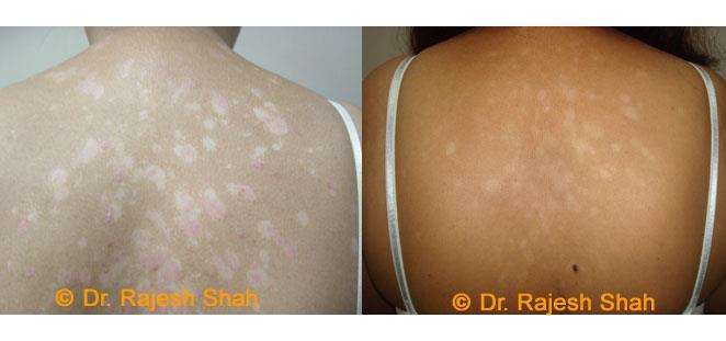 Psoriasis Before and After Case Photo