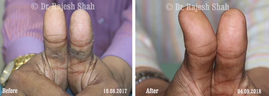 Psoriasis Before and After Case Photo