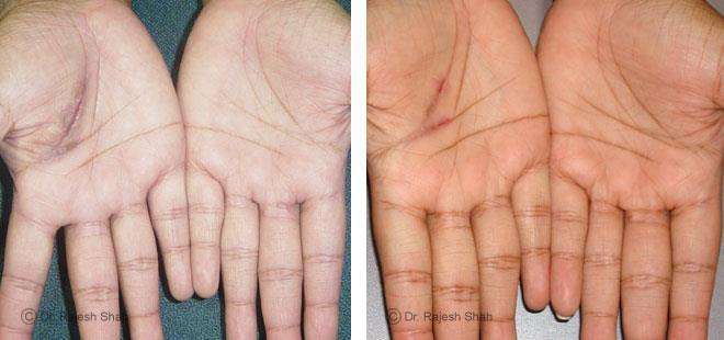 Eczema Before and After Case Photo