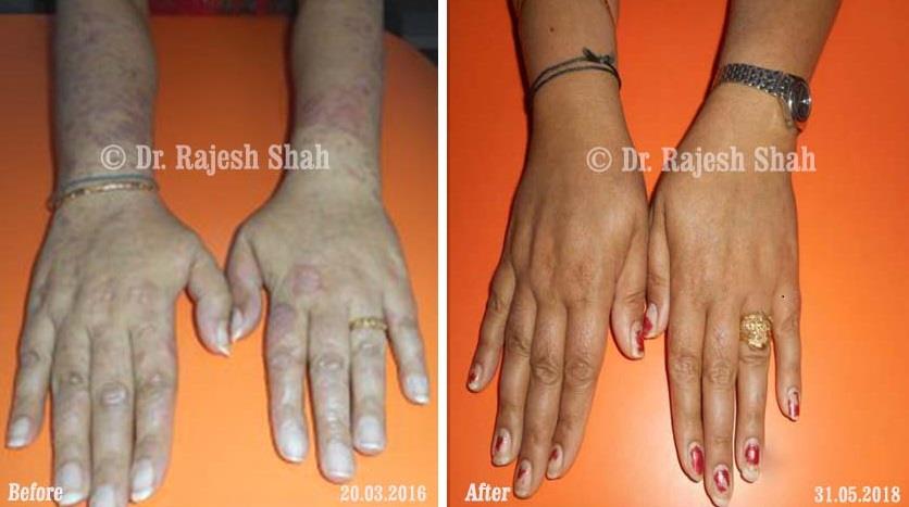 Psoriasis Before and After Case Photo