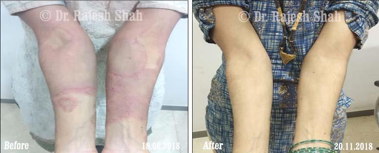 Psoriasis Before and After Case Photo