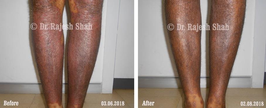 Psoriasis Before and After Case Photo