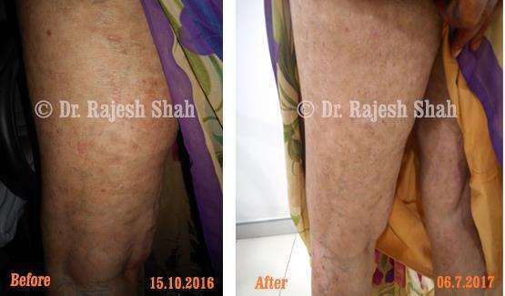 Psoriasis Before and After Case Photo