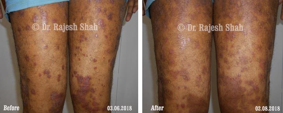 Psoriasis Before and After Case Photo