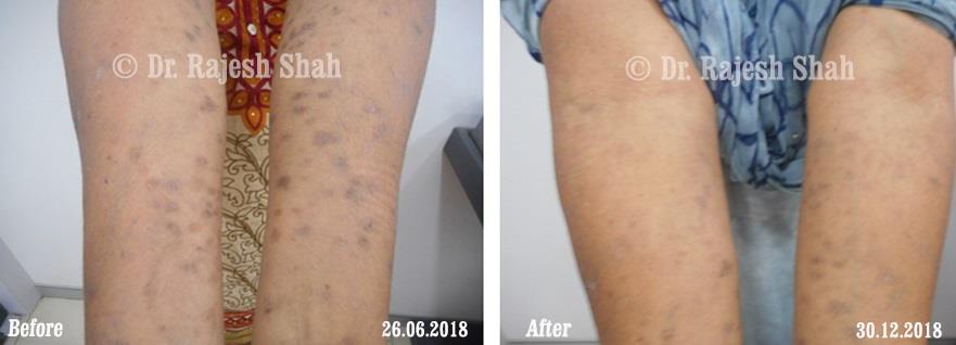 Lichen Planus Before and After Case Photo
