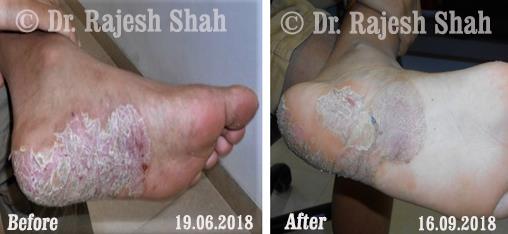 Psoriasis Before and After Case Photo