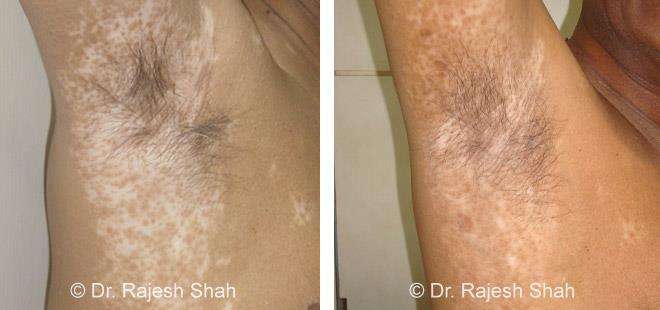 Vitiligo Before and After Case Photo