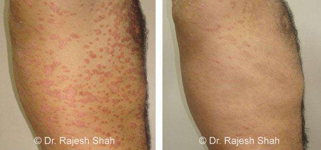 Psoriasis Before and After Case Photo