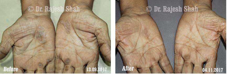 Psoriasis Before and After Case Photo