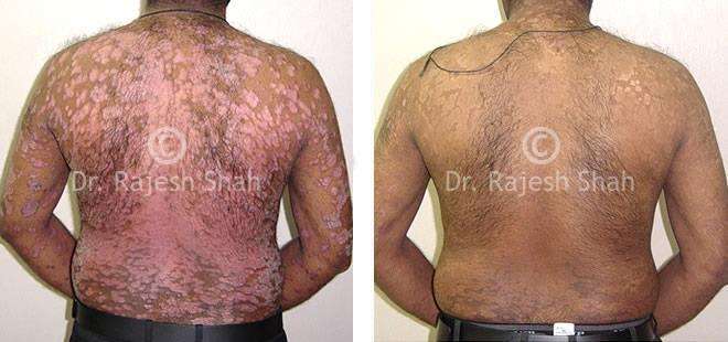 Psoriasis Before and After Case Photo