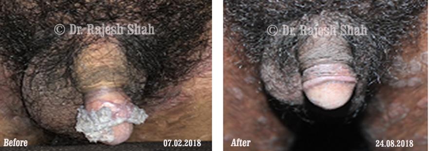 Warts Before and After Case Photo