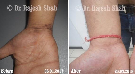 Lichen Planus Before and After Case Photo