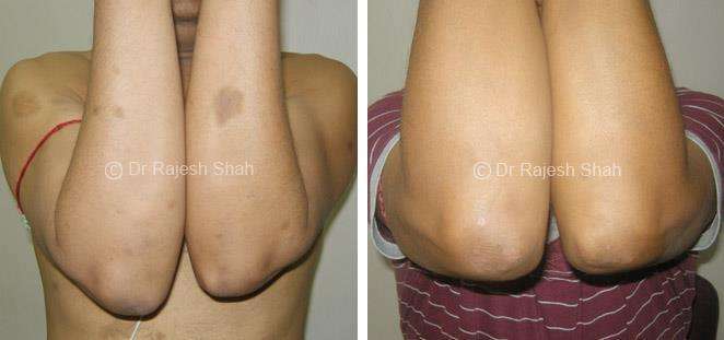 Psoriasis Before and After Case Photo