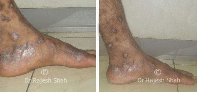 Lichen Planus Before and After Case Photo