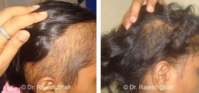 Hair loss Before and After Case Photo