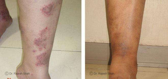 Eczema Before and After Case Photo