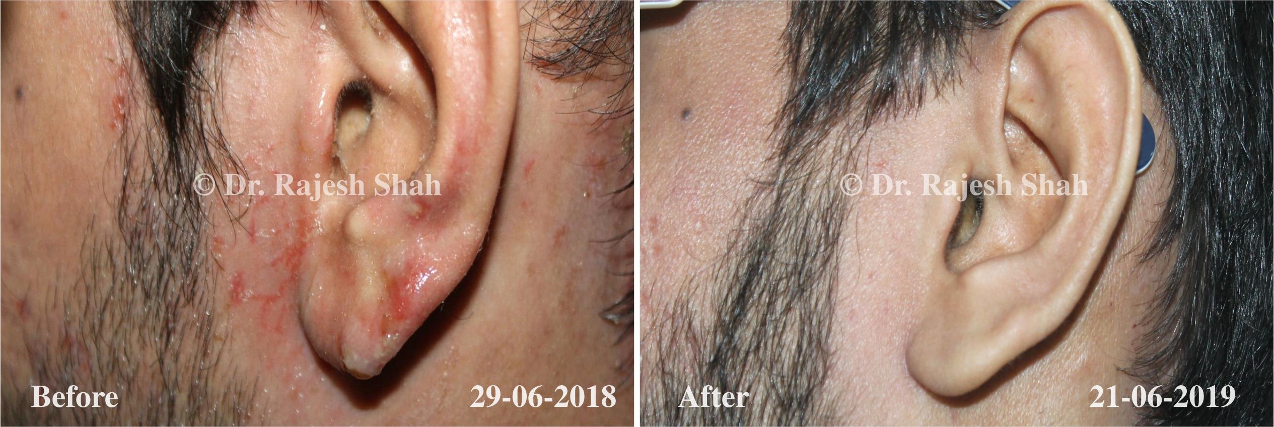 Atopic Dermatitis Before and After Case Photo