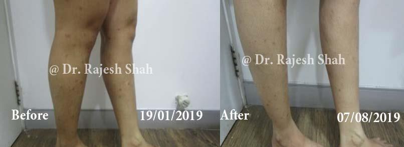 Psoriasis Before and After Case Photo