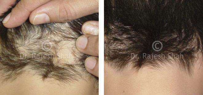 Alopecia Areata Before and After Case Photo