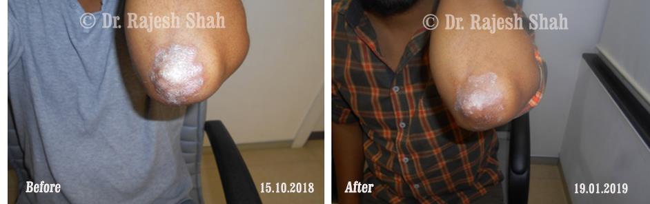 Psoriasis Before and After Case Photo