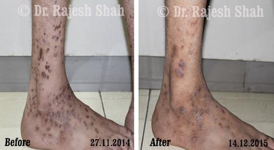 Lichen Planus Before and After Case Photo