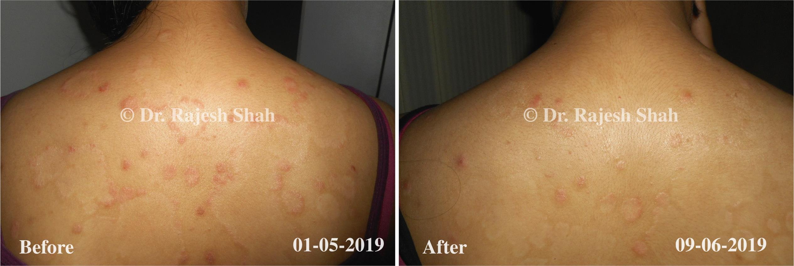 Psoriasis Before and After Case Photo
