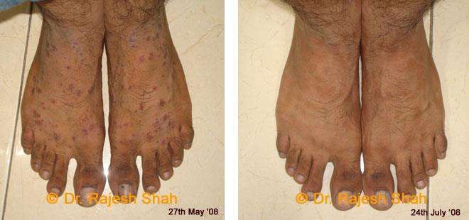 Psoriasis Before and After Case Photo